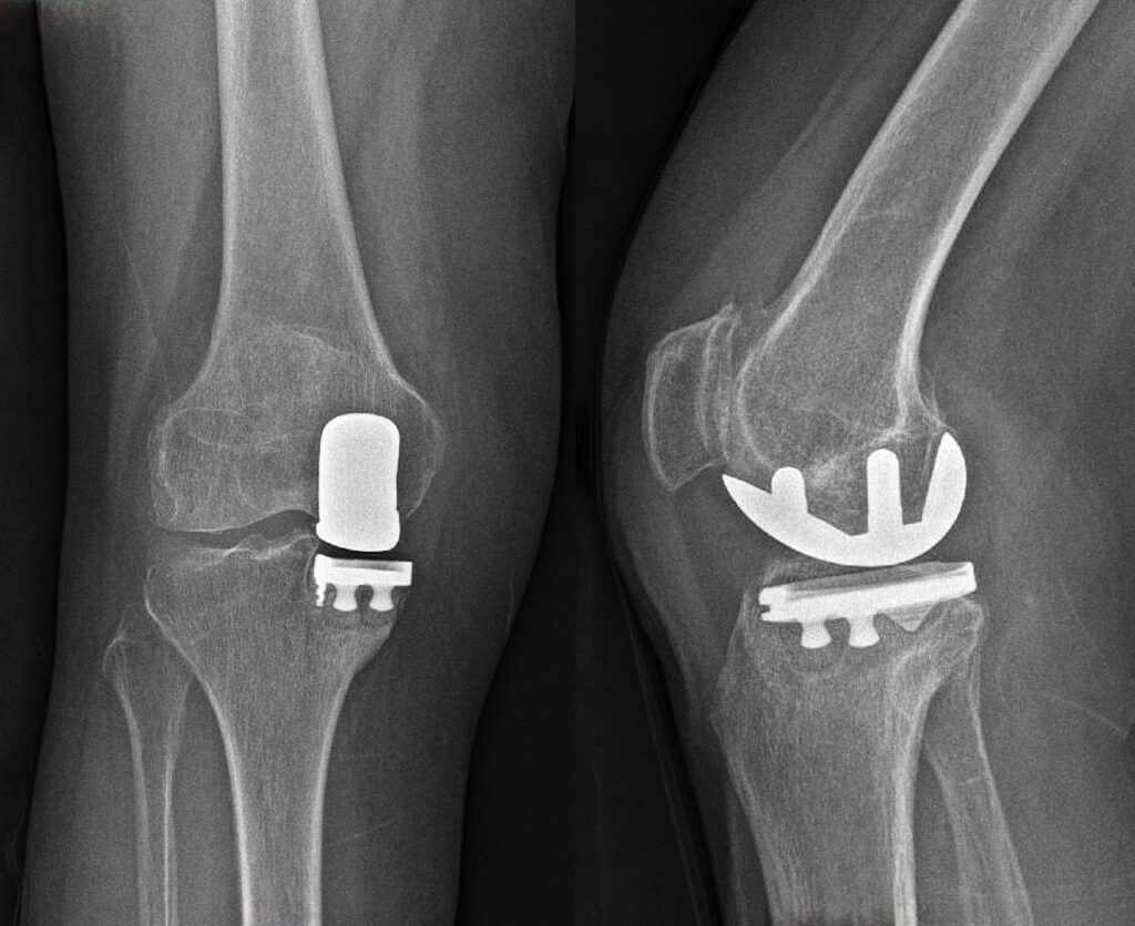 Partial Knee Replacement X-Ray stock photo
